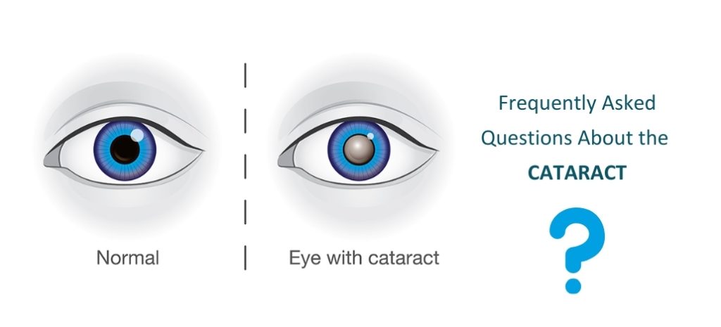 frequently asked questions about cataract 1024x465